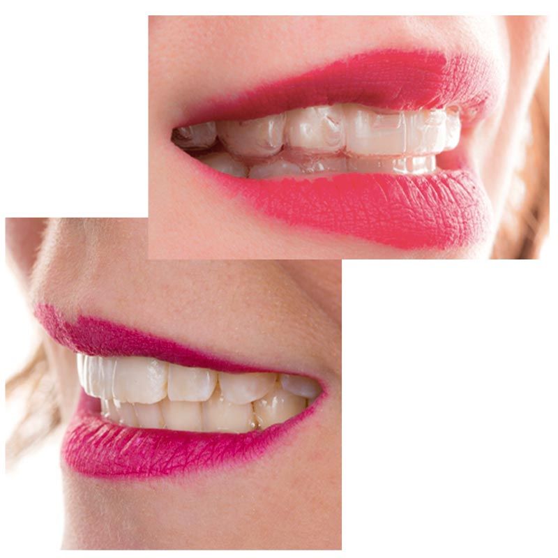 Tratamiento ortodoncia invisible antes y después