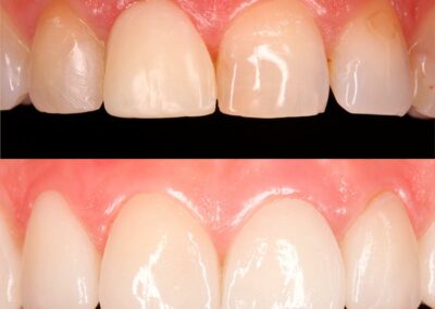 Antes y después de un tratamiento estético con carillas dentales