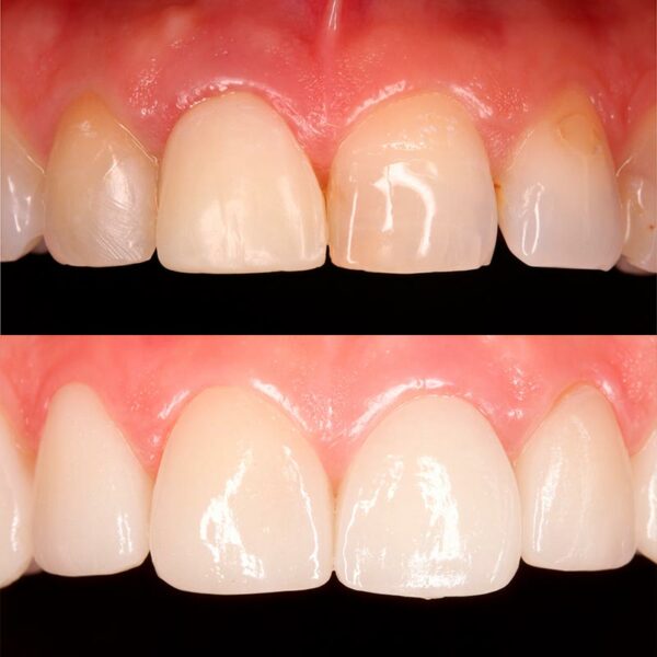 Antes y después de un tratamiento estético con carillas dentales