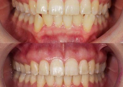 Antes y después en un tratamiento estético de ortodoncia invisible
