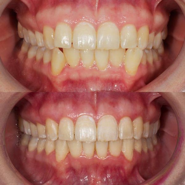 Antes y después en un tratamiento estético de ortodoncia invisible
