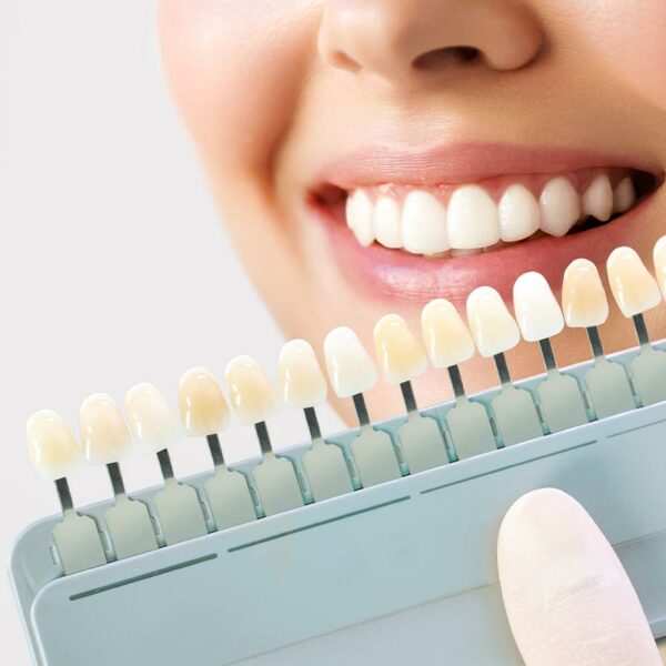 Escala de tonos dentales