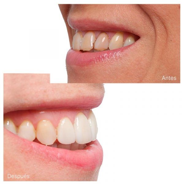 Tratamiento de carillas dentales antes y después